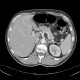 Stenosis of sigmoid colon and lienal flexure, inflammatory stenosis, CT colonography: CT - Computed tomography